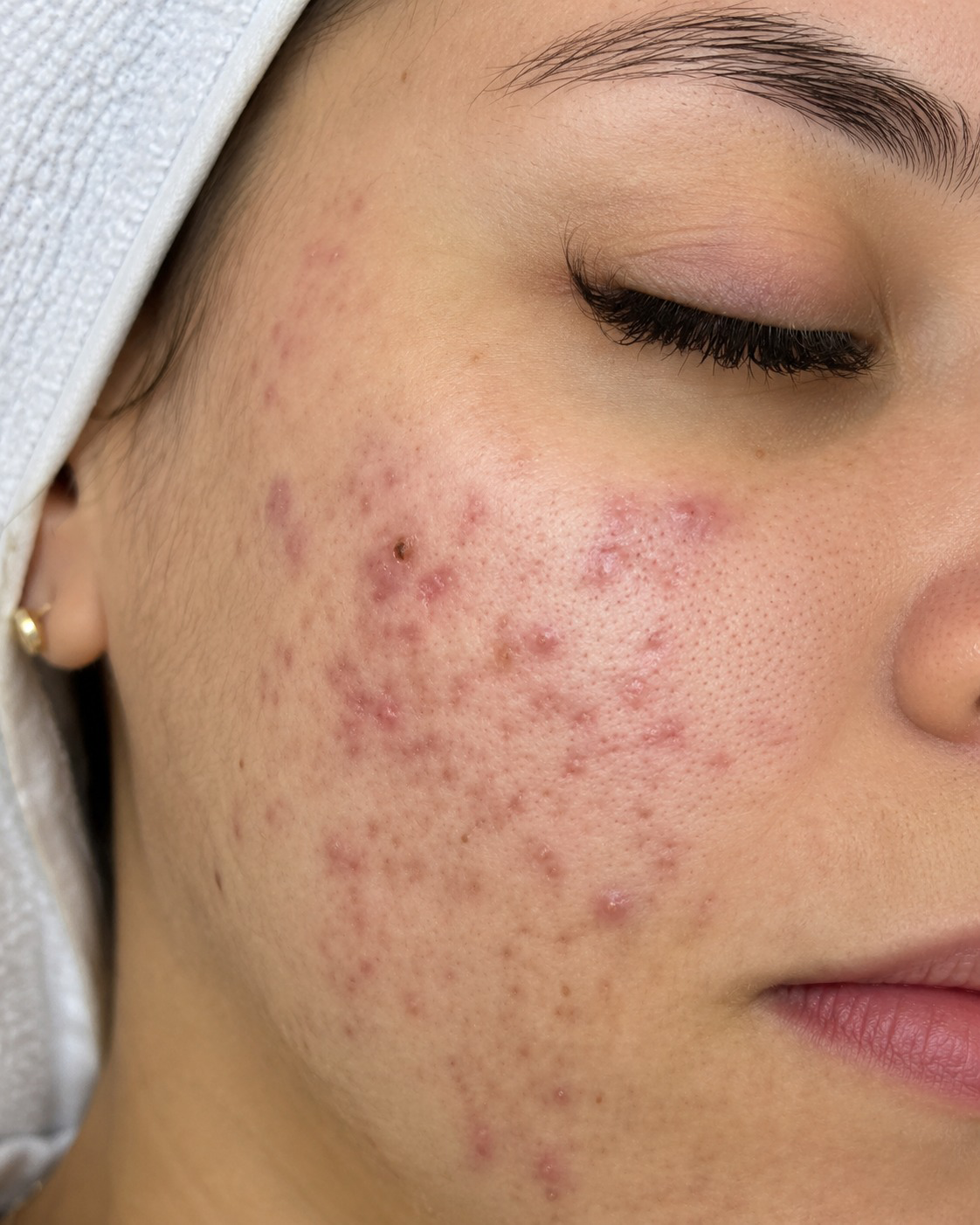 Pele antes do tratamento de acne