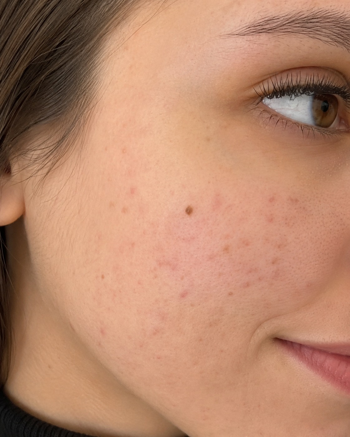 Pele depois do tratamento de acne